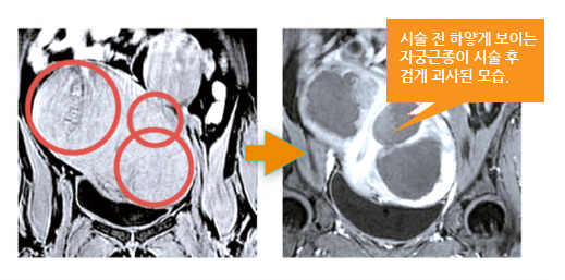 MRI-하이푸 치료 전후 사진